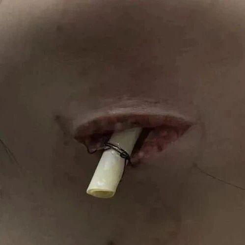 拔牙后我肿出了双下巴，医生还在上面打了个洞……