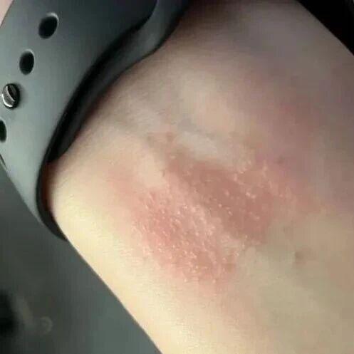“手环的光能把皮肤烧坏!”运动手环的受害者越来越多?